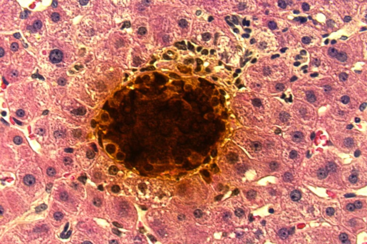 1º transplante com terapia celular para diabetes elimina uso de insulina nos EUA