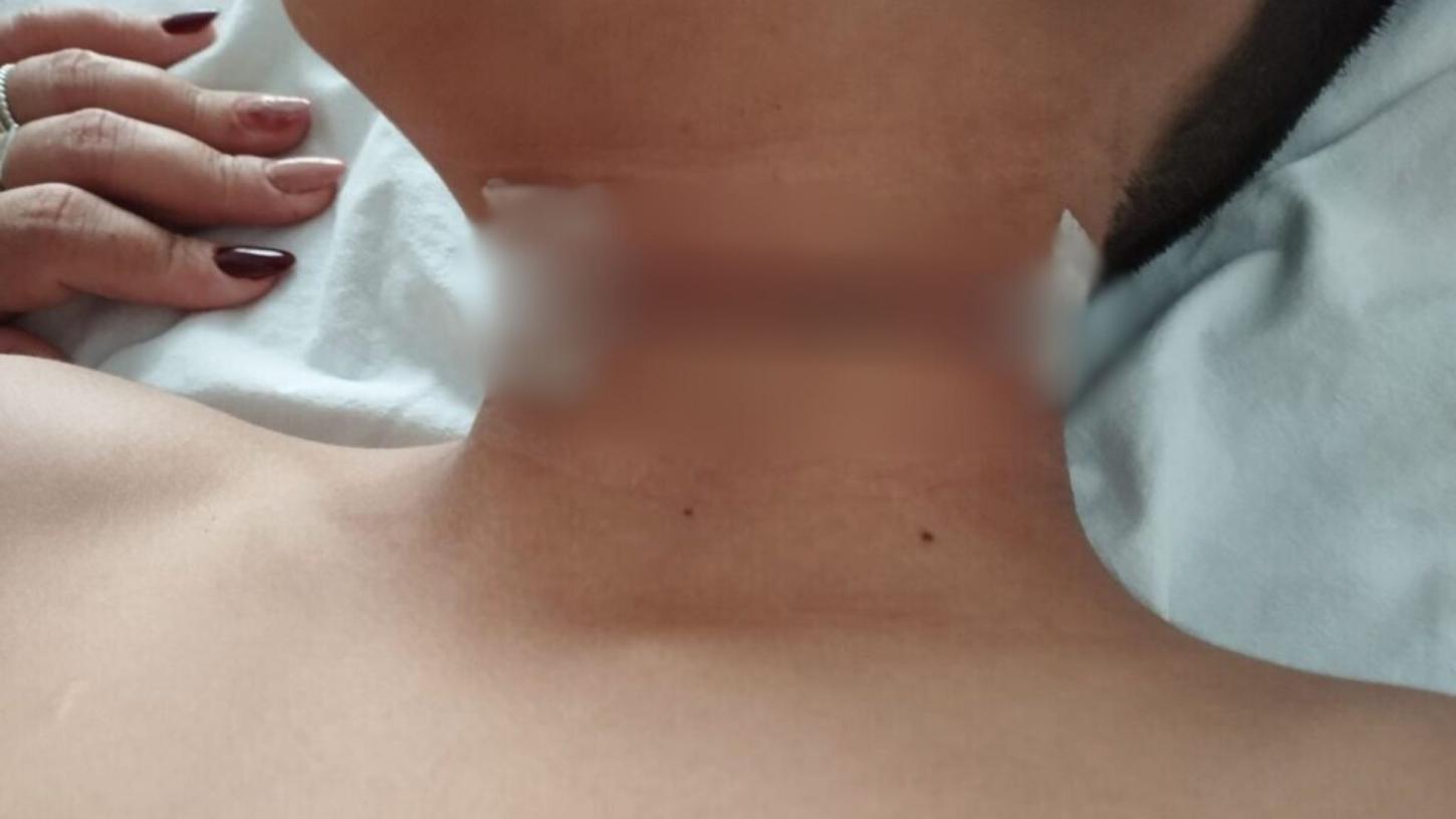 Linha de pipa: criança fica ferida em acidente em Tupã (SP)