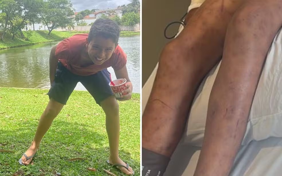 Menino de 9 anos que foi picado por abelhas da cabeça aos pés morre no hospital