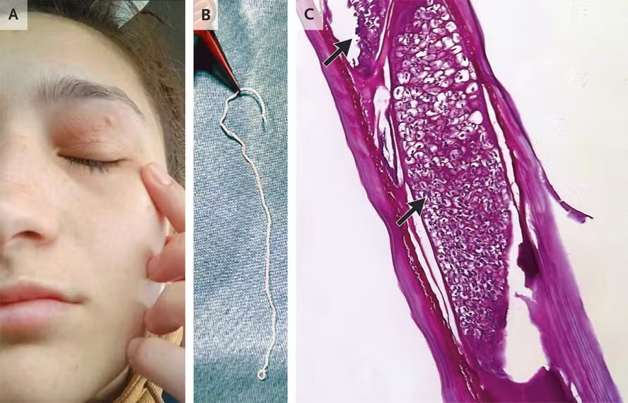 Mulher tem verme de 11 cm removido da pálpebra