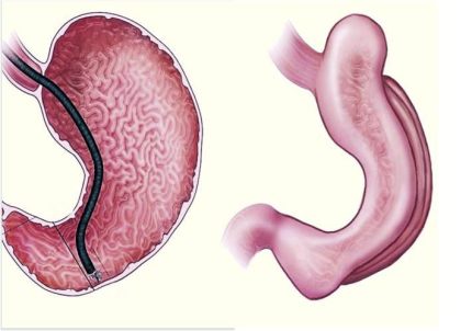 Obesidade: Um procedimento sem cortes emerge como opção à cirurgia bariátrica e aos medicamentos injetáveis