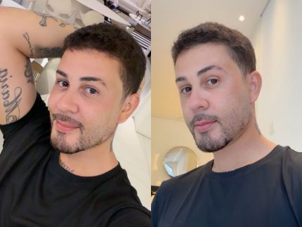 Carlinhos Maia ressurge na internet e detalha procedimento estético facial