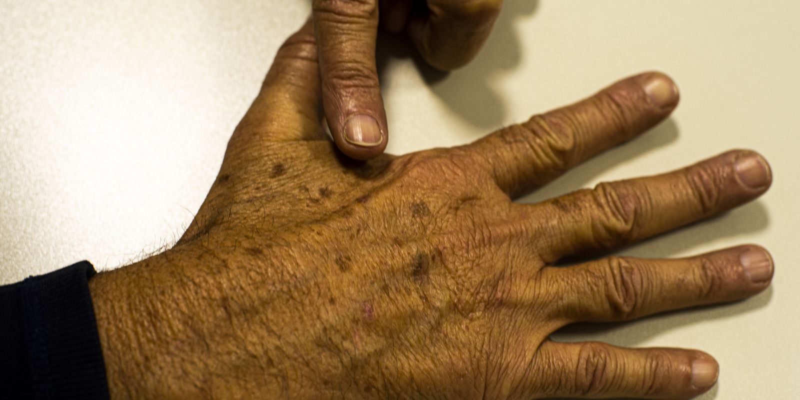 Falta de dados sobre câncer de pele prejudica políticas públicas, aponta instituição