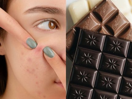 Cuidado com a pele após a Páscoa: como lidar com a acne depois do excesso de chocolate