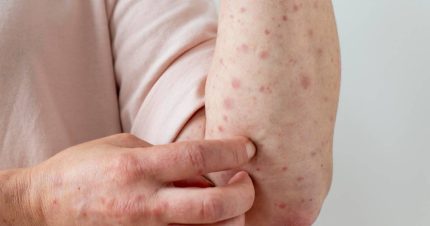 Surto de sarampo em nações da Copa do Mundo acende alerta para o Brasil