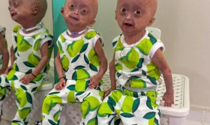 Elis, uma das gêmeas brasileiras diagnosticadas com síndrome rara, morre aos 5 anos