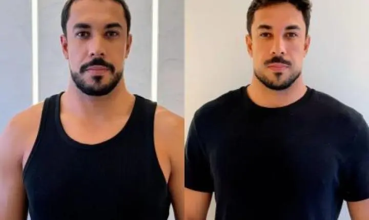 Ex-BBB Maike Allan faz harmonização facial e explica receio de perder a naturalidade