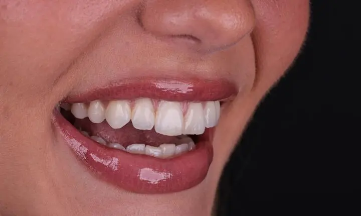 Miss Brasil Universo 2026, Marcella Kozinski renova o sorriso; veja antes e depois