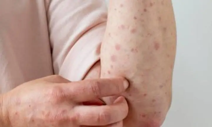 Surto de sarampo em nações da Copa do Mundo acende alerta para o Brasil